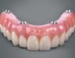 All-on-4 Dental Implants: The Complete Guide to “Teeth in a Day”