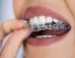 Understanding Clear Aligners: A Modern Approach to a Straighter Smile