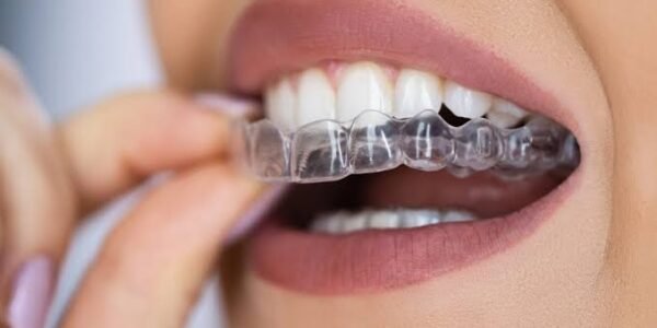 Understanding Clear Aligners: A Modern Approach to a Straighter Smile