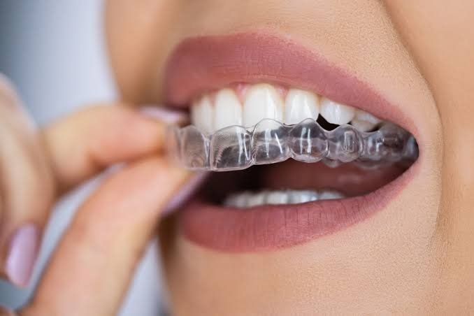 Understanding Clear Aligners: A Modern Approach to a Straighter Smile