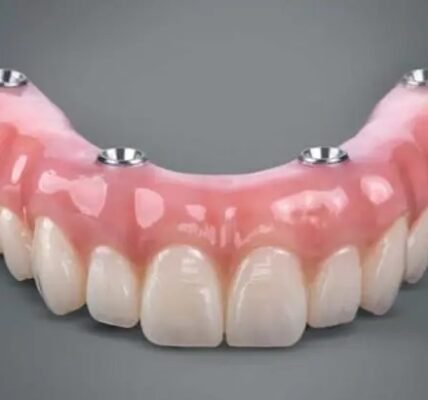All-on-4 Dental Implants: The Complete Guide to “Teeth in a Day”