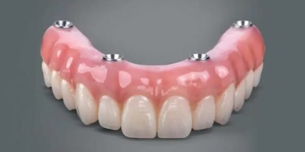 All-on-4 Dental Implants: The Complete Guide to “Teeth in a Day”
