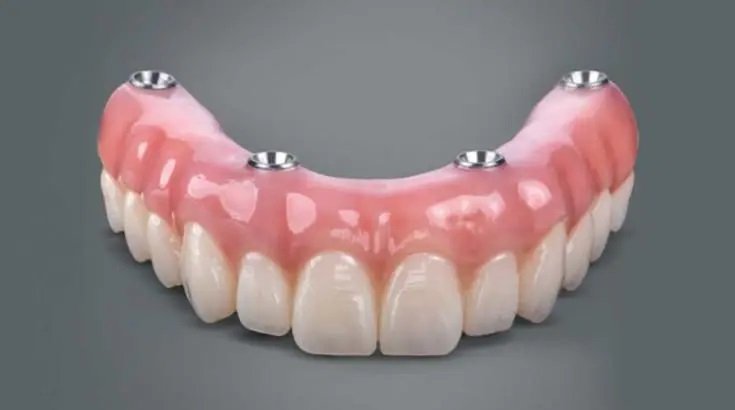 All-on-4 Dental Implants: The Complete Guide to “Teeth in a Day”